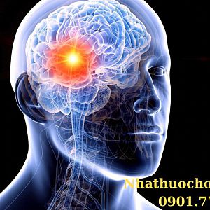 Ung thư não: Nguyên nhân, điều trị và cách phòng ngừa