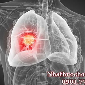 Những loại thuốc điều trị ung thư phổi bạn nên biết