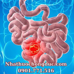 Ung thư ruột non - Dấu hiệu, chẩn đoán cùng cách điều trị