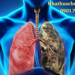 Ung thư phổi: Tổng quan về dấu hiệu, chẩn đoán và cách điều trị