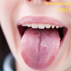 Ung thư lưỡi: Nguyên nhân, phòng và cách điều trị