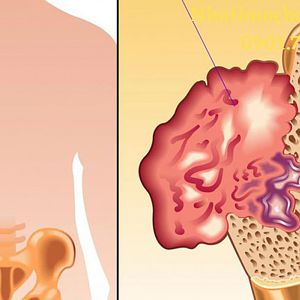 Ung thư xương là gì và những nguyên nhân gây ung thư xương