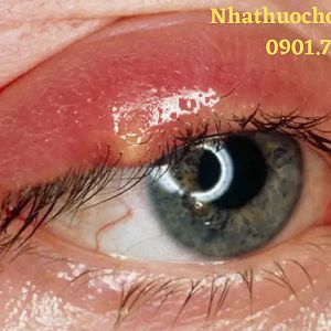 Ung thư mắt: nguyên nhân, chẩn đoán, điều trị