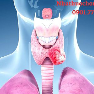 Ung thư tuyến giáp: Nguyên nhân, dấu hiệu và hướng điều trị