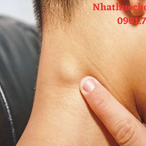 Ung thư hạch là gì? Nguyên nhân và cách điều trị