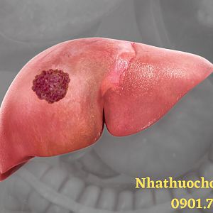 Ung thư gan di căn là gì? Dấu hiệu của bệnh ung thư gan di căn