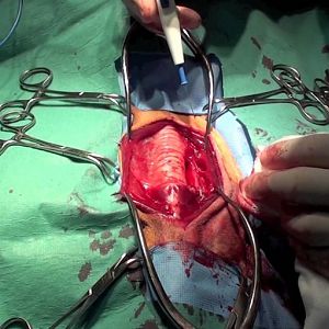 Phẫu thuật ung thư tuyến giáp: quy trình, hồi phục và biến chứng