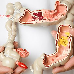 Ung thư hậu môn: Dấu hiệu cảnh báo sớm bệnh ung thư hậu môn