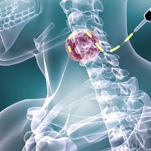 Phương pháp chẩn đoán ung thư hạch không Hodgkin cực chuẩn