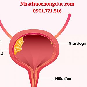 Nguyên nhân và cách điều trị ung thư bàng quang