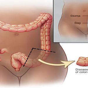 Nguyên nhân, điều trị ung thư ruột và phòng ngừa